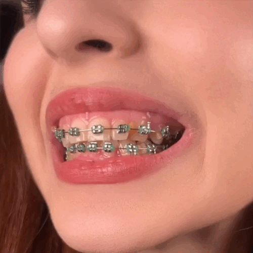 No más comida atorada en tus brackets: limpia fácil, rápido y sin esfuerzo ¡Prueba esto!